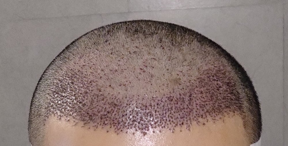 Post-op 2.jpg