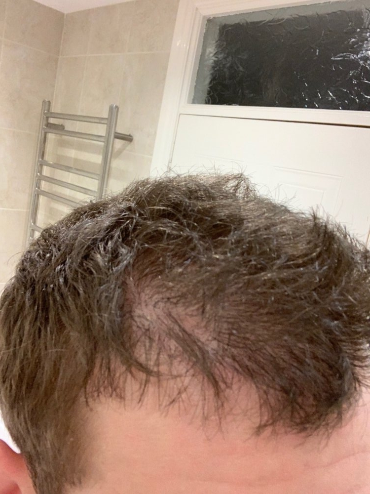 Post transplant.jpg