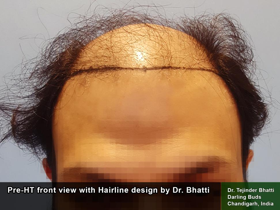 My Hairtransplant story with Dr. Tejinder Bhatti | Hair loss Forum - Hair  Transplant forums