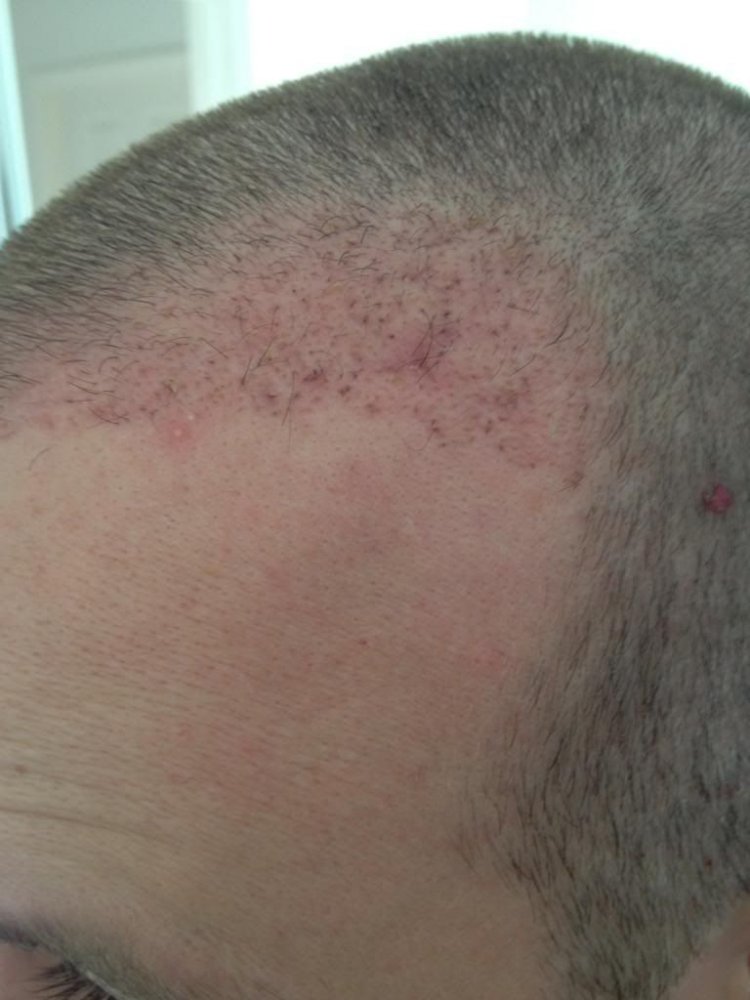 Pro hair clinic Belgium 2 months post op 1.jpg