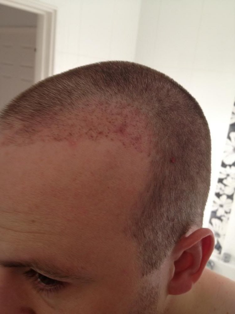 Pro hair clinic Belgium 2 months post op.jpg