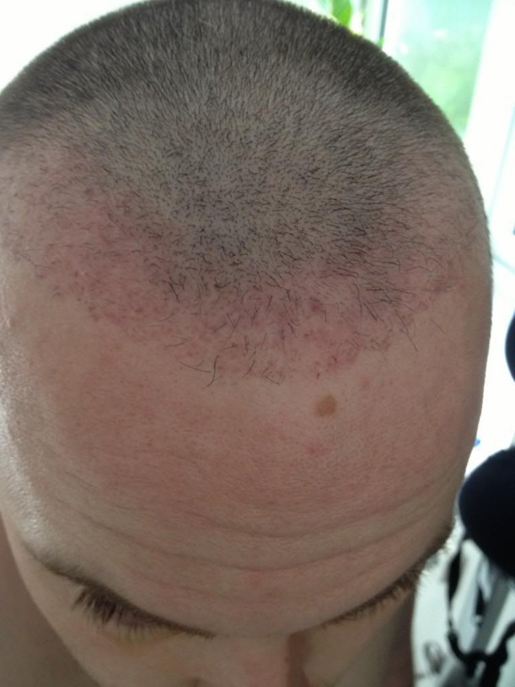 Pro hair clinic Belgium 2 months post op3.jpg