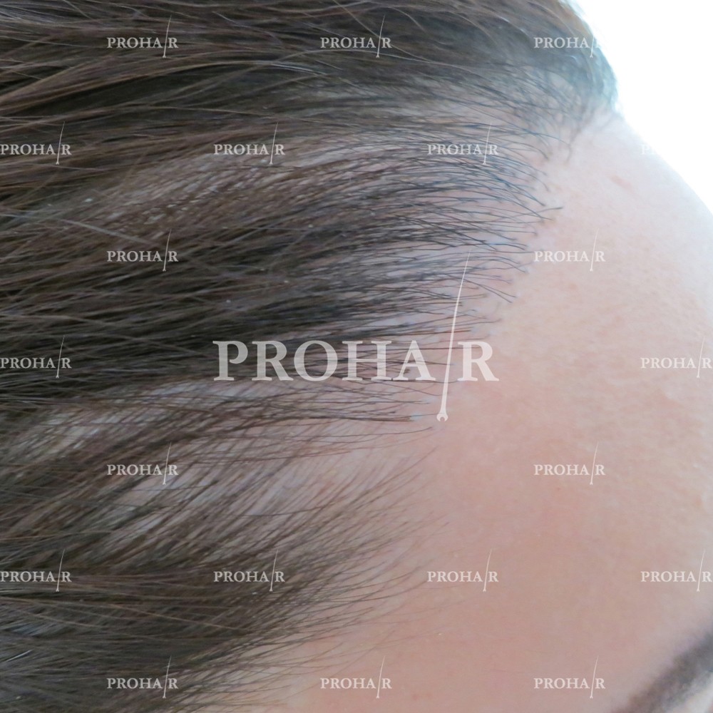 PROHAIR-hair-transplant-clinic-1000-NLHT-06.jpg