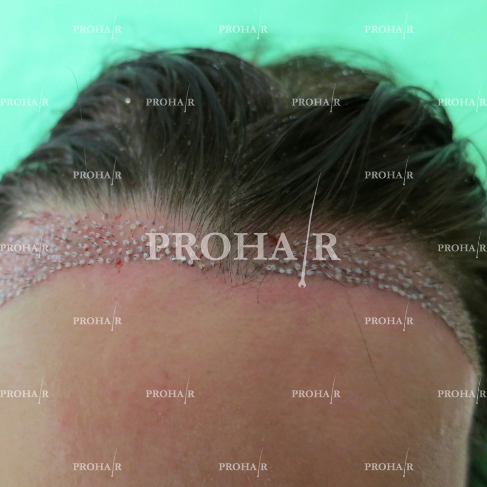 PROHAIR-hair-transplant-clinic-1500-NLHT-02.jpg