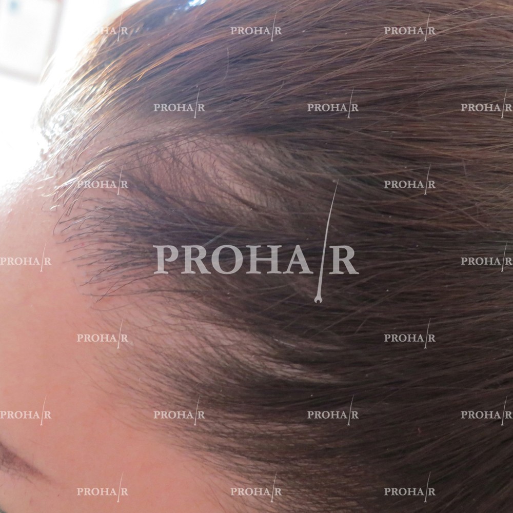 PROHAIR-hair-transplant-clinic-1500-NLHT-03.jpg