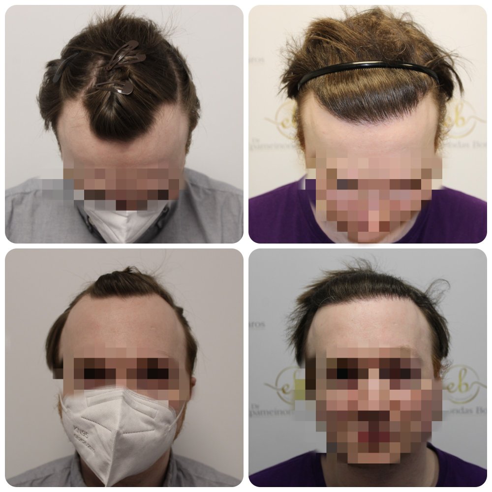 receding-hairline-transplant-results-glasgow-dr-bonaros.jpg