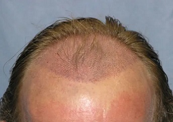 recipient sites for hair transplant.jpg