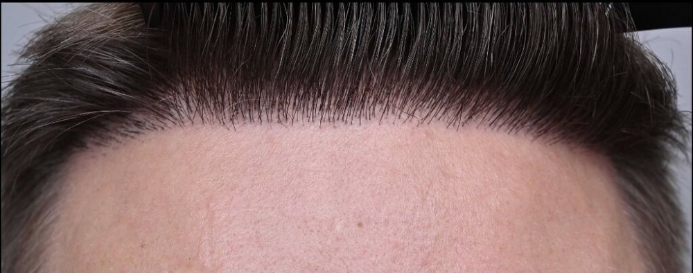 Repair of unnatural hairline.jpeg