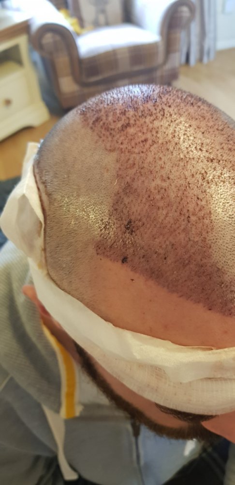 Right side 1 day post fue.jpg