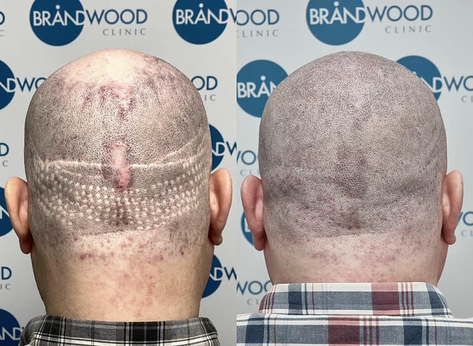 scar repair.jpg