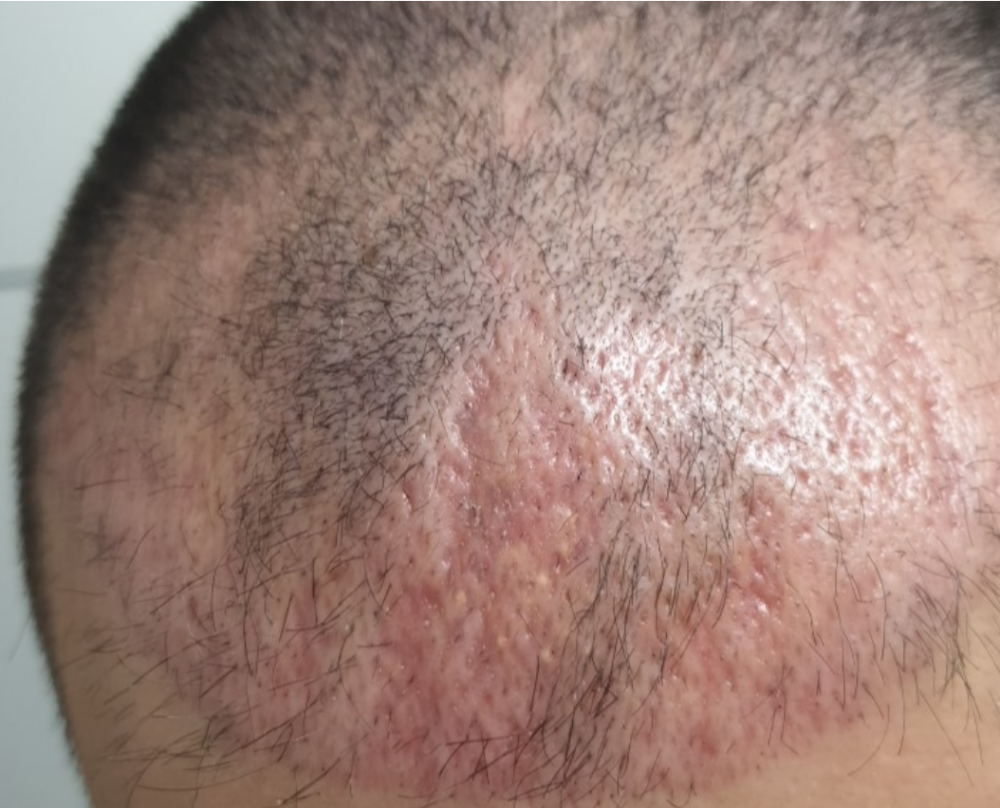 Scratches after hair transplant..png