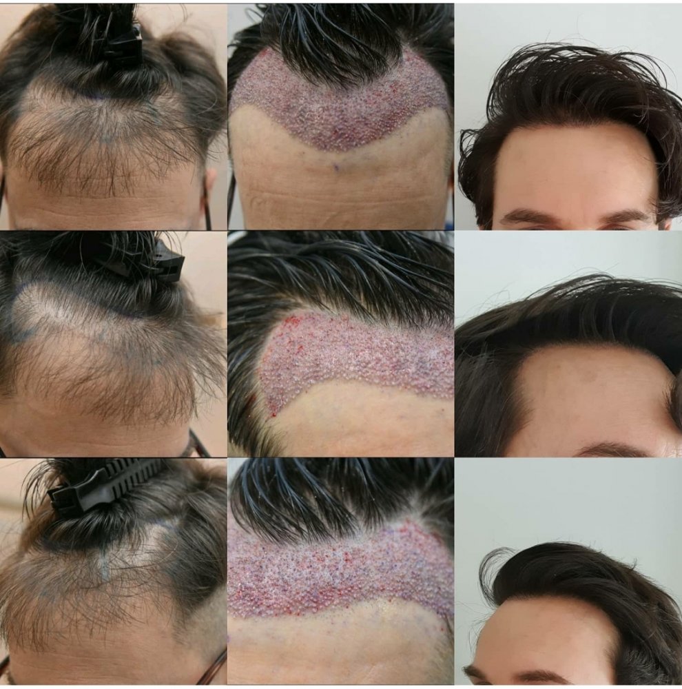 Dr. Lupanzula, Medikemos, repair case - 1555 FUs + 12 x plug removal - 1  year post-op | Hair loss Forum - Hair Transplant forums