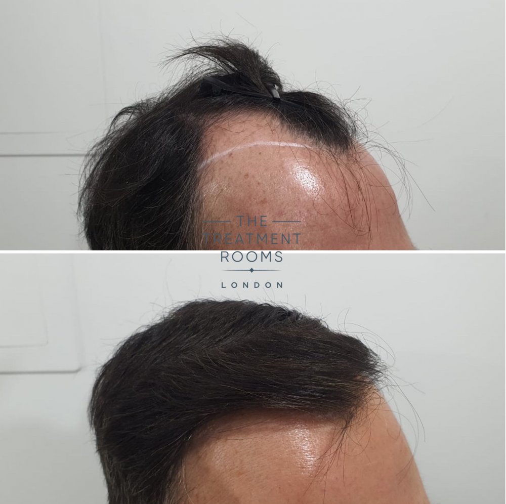 Temple FUE hair transplant before and after 1800 grafts.jpg
