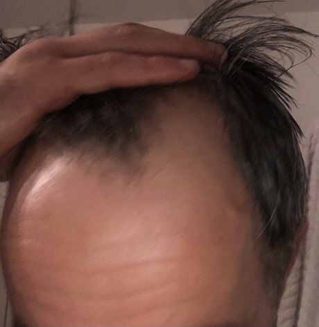 Temple hair loss 2.jpeg