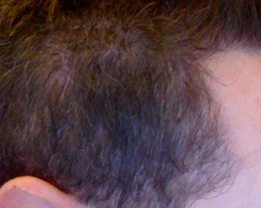 Temple points post op.png
