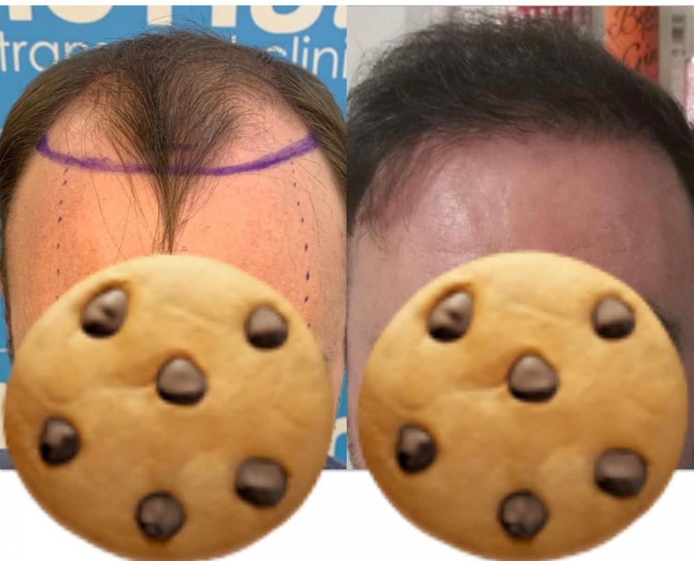 The Hair Dr Leeds before and 12 months result.jpeg
