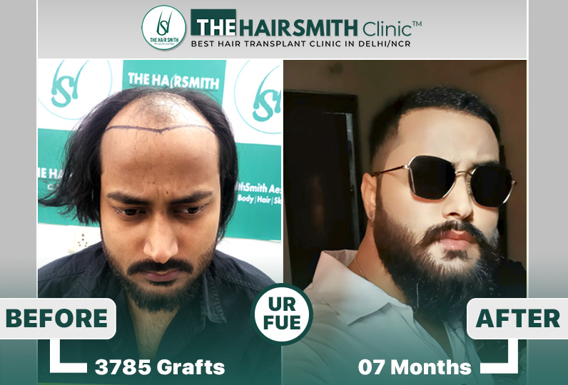 the hairsmith clinic hair transplant result - after 11 months.jpg