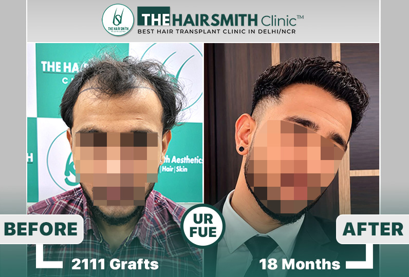 the hairsmith clinic hair transplant result #hairtransplant #hairsmithhairtransplant #hairregr...JPG
