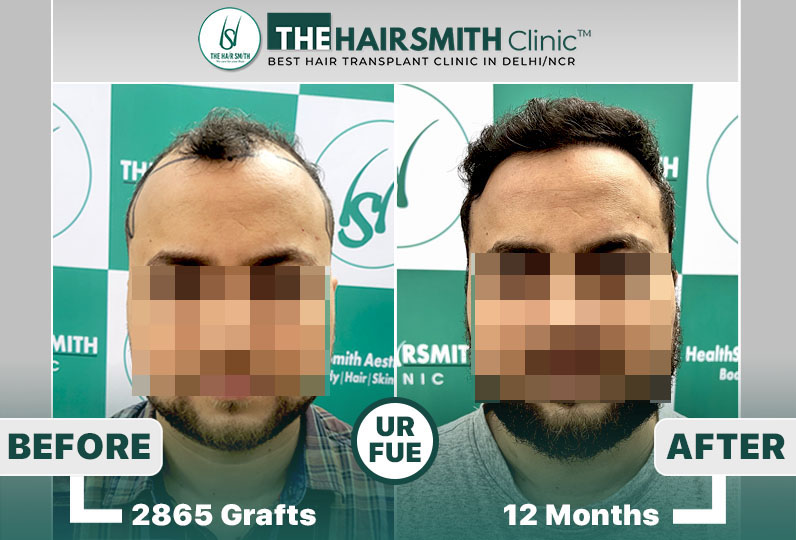 the hairsmith clinic hair transplant result #hairtransplant #hairsmithhairtransplant.jpg