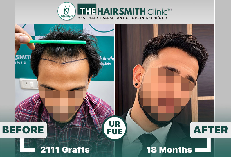 the hairsmith clinic hair transplant result #hairtransplant #hairsmithhairtransplant.JPG