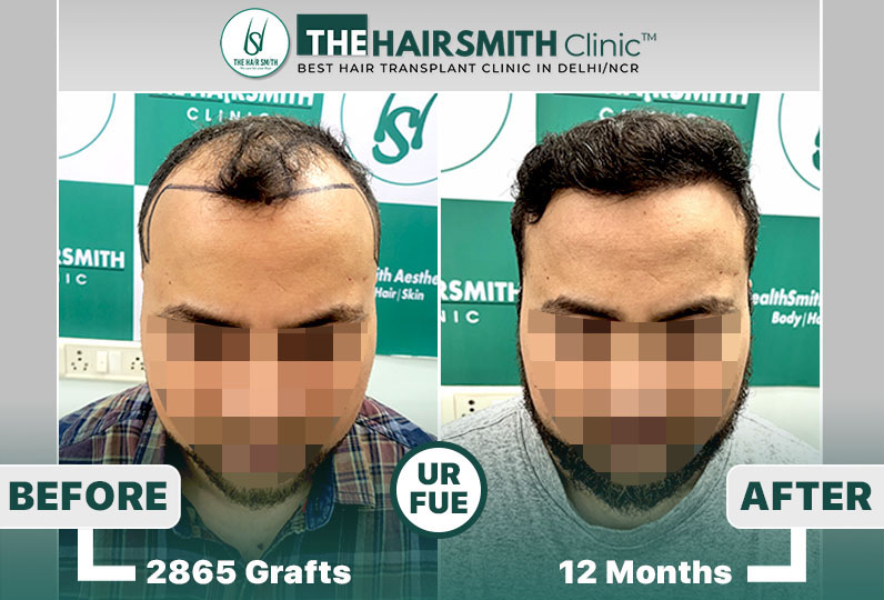 the hairsmith clinic hair transplant result #hairtransplant.jpg
