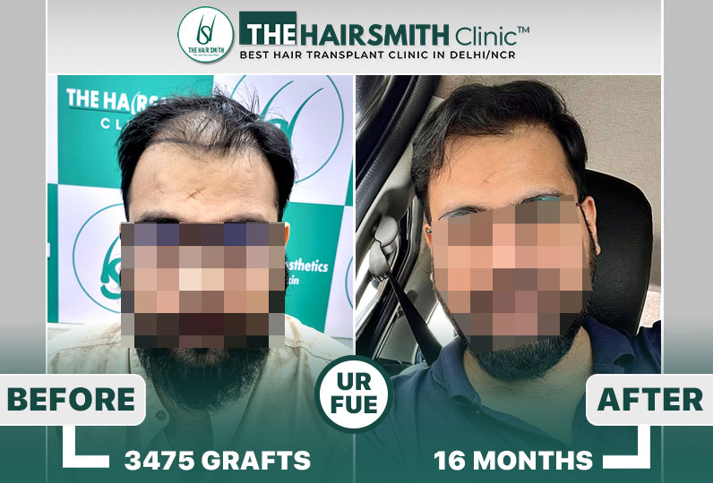 The Hairsmith Hair Transplant Results #HairTransplant #HairTransplantResult.jpg