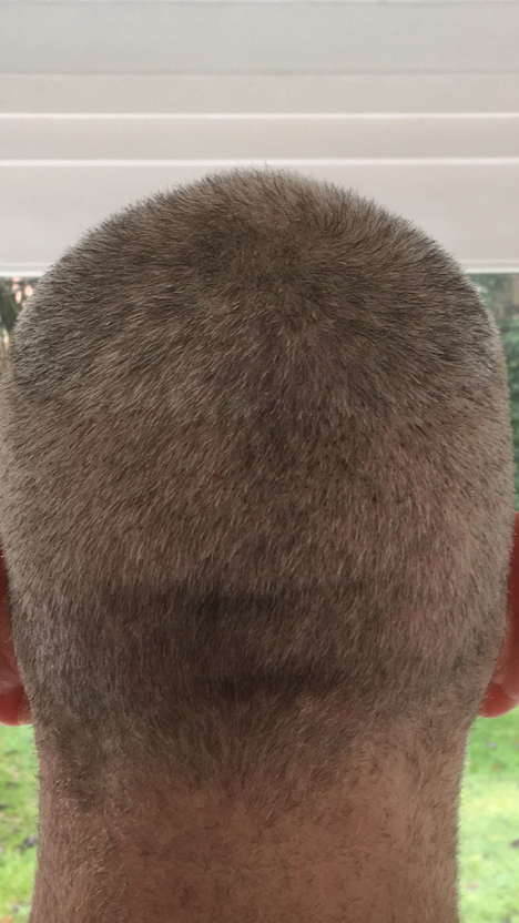 The Maitland clinic donor area after FUE.PNG