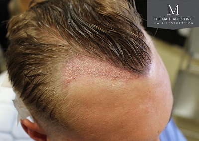 The-Maitland-Clinic-Dr-Ball-FUE-Immediate-Post-Op.jpg