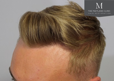 The-Maitland-Clinic-Dr-Ball-FUE-Post-Op-2-years.jpg