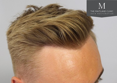 The-Maitland-Clinic-Dr-Ball-FUE-Post-Op-2-years..jpg