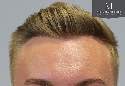 The Maitland Clinic hair transplant 2.jpg
