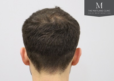 The Maitland Clinic hair transplant _After_back.jpg