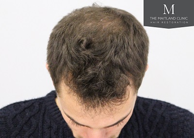 The Maitland Clinic hair transplant _After_front_top.jpg