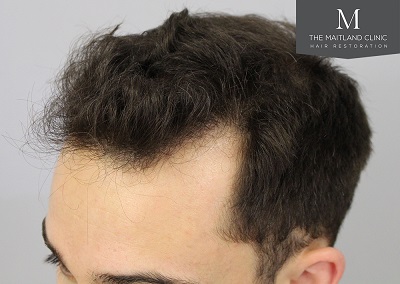 The Maitland Clinic hair transplant _After_Hairline_drawn.jpg