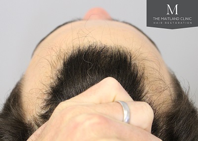 The Maitland Clinic hair transplant  - After_Above_hairline.jpg