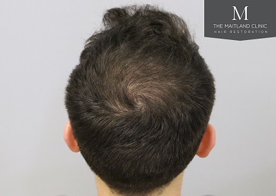 The Maitland Clinic hair transplant - After_Crown.jpg