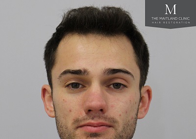 The Maitland Clinic hair transplant  - After_front.jpg