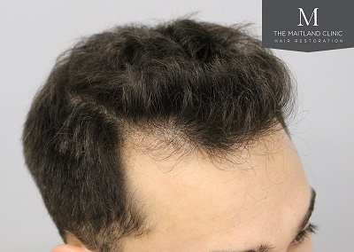 The Maitland Clinic hair transplant  - After_Hairline_drawn_right.jpg