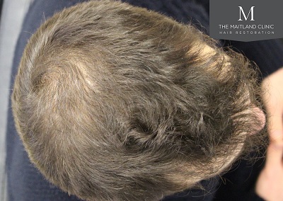 The Maitland Clinic hair transplant - After_Top.jpg