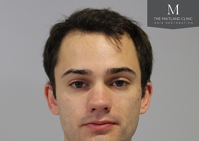 The Maitland Clinic hair transplant - Before front.jpg