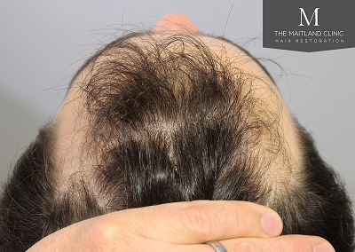 The Maitland Clinic hair transplant  - Before_Above_hairline.jpg