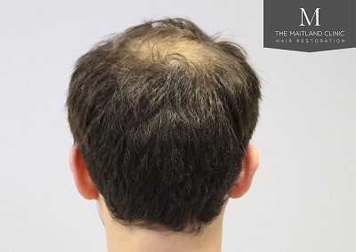 The Maitland Clinic hair transplant  - Before_back.jpg