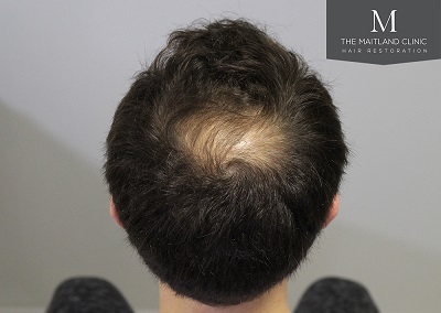 The Maitland Clinic hair transplant  - Before_Crown.jpg
