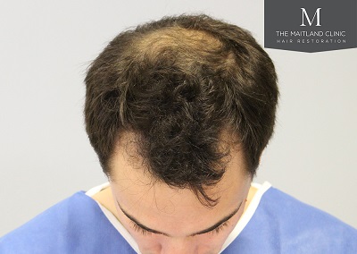 The Maitland Clinic hair transplant  - Before_front_top.jpg