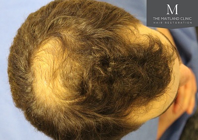 The Maitland Clinic hair transplant  - Before_Top.jpg