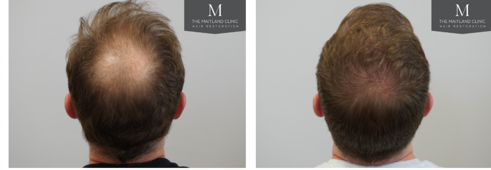 The Maitland clinic hair transplant Dr Ball.png