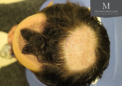 The Maitland Clinic hair transplant  - graft placenent_above.jpg