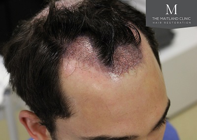 The Maitland Clinic hair transplant  - graftplacenent_right1.jpg