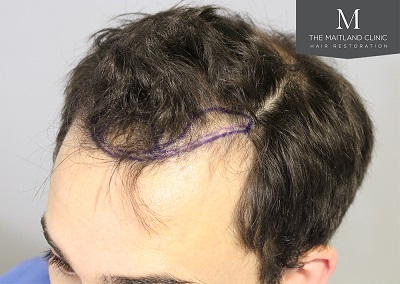 The Maitland Clinic hair transplant  - Hairline_drawn.jpg