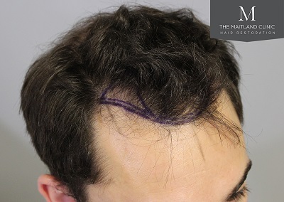 The Maitland Clinic hair transplant  - Hairline_drawn_right.jpg